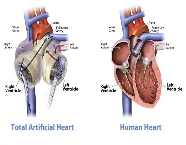 مکانیزم قلب مصنوعی